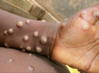 Türkiyədə bir nəfər meymunçiçəyi xəstəliyinə yoluxma şübhəsi ilə karantinə alındı